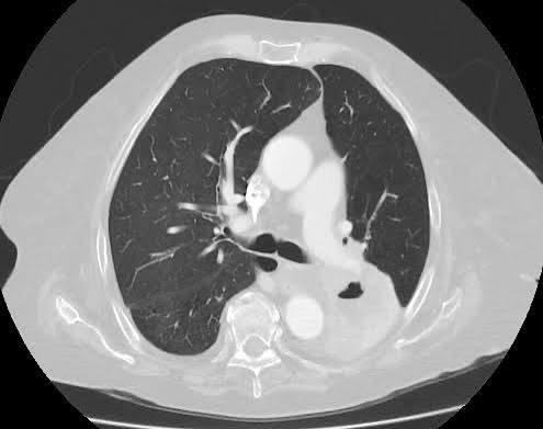 CT scan showing lung cancer